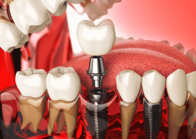 Viti per impianti dentali guida completa