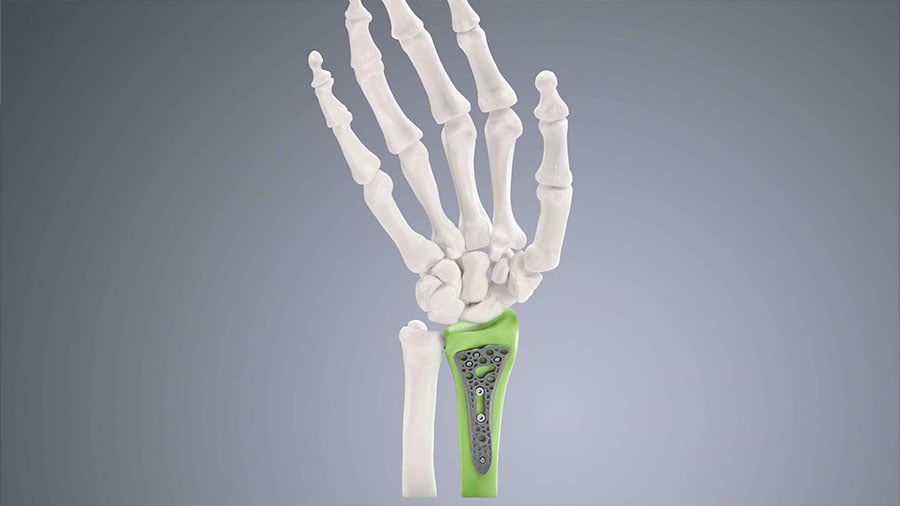 Tecniche avanzate di SLM nella stampa 3D
